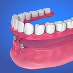 Storia degli impianti dentali: chi li ha inventati?